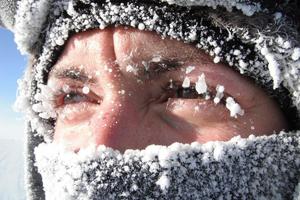 1334обморожения1343134143413